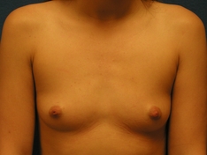 Breast Augmentation