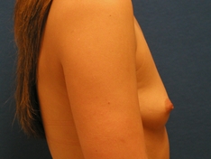 Breast Augmentation