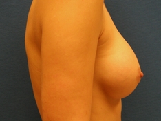 Breast Augmentation