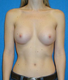 Breast Augmentation