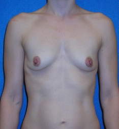 Breast Augmentation