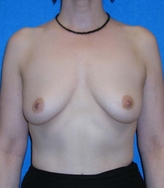 Breast Augmentation