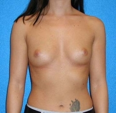 Breast Augmentation