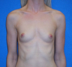 Breast Augmentation