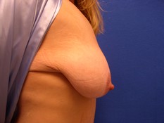 Breast Lift