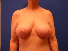 Breast Lift