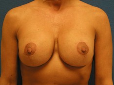 Breast Lift