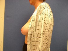 Breast Reconstruction