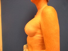 Breast Reconstruction