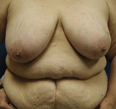 Breast Reconstruction