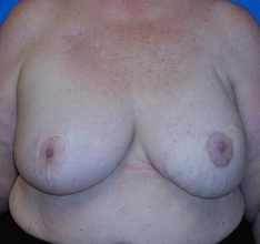 Breast Reconstruction