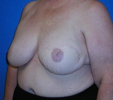 Breast Reconstruction