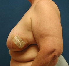 Breast Reconstruction