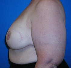 Breast Reconstruction