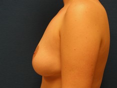 Breast Reduction