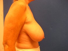 Breast Reduction