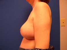 Breast Reduction