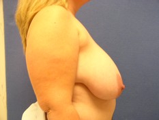 Breast Reduction