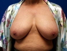 Breast Reduction