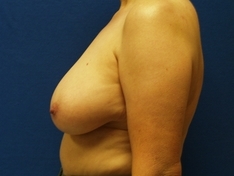 Breast Reduction