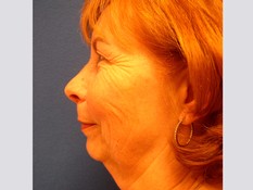 Facelift/Necklift