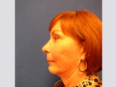 Facelift/Necklift