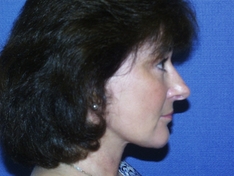 Facelift/Necklift