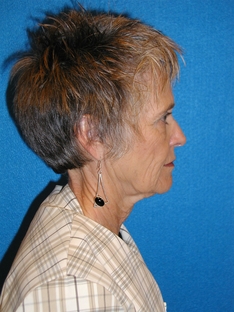 Facelift/Necklift