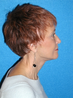 Facelift/Necklift