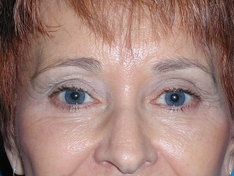 Facelift/Necklift