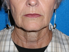 Facelift/Necklift