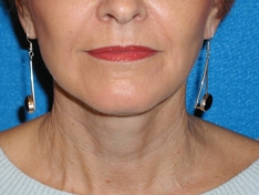 Facelift/Necklift