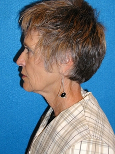 Facelift/Necklift