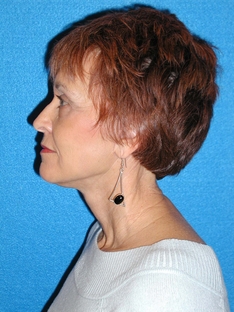 Facelift/Necklift