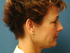 Facelift/Necklift