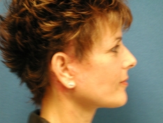 Facelift/Necklift