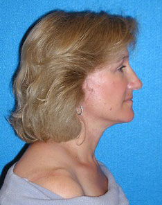 Facelift/Necklift