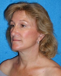 Facelift/Necklift