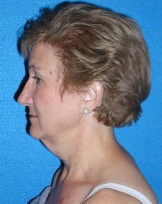 Facelift/Necklift