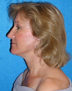 Facelift/Necklift