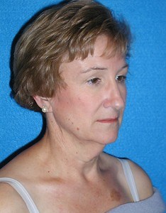 Facelift/Necklift