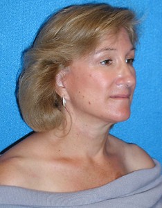 Facelift/Necklift