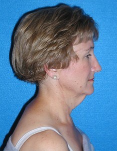 Facelift/Necklift