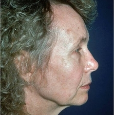 Facelift/Necklift