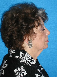 Facelift/Necklift