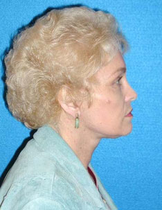 Facelift/Necklift