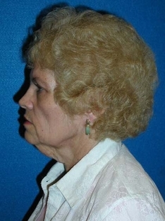 Facelift/Necklift