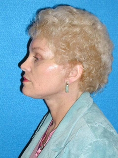 Facelift/Necklift