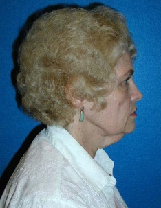 Facelift/Necklift