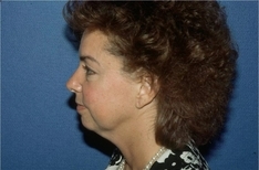 Facelift/Necklift